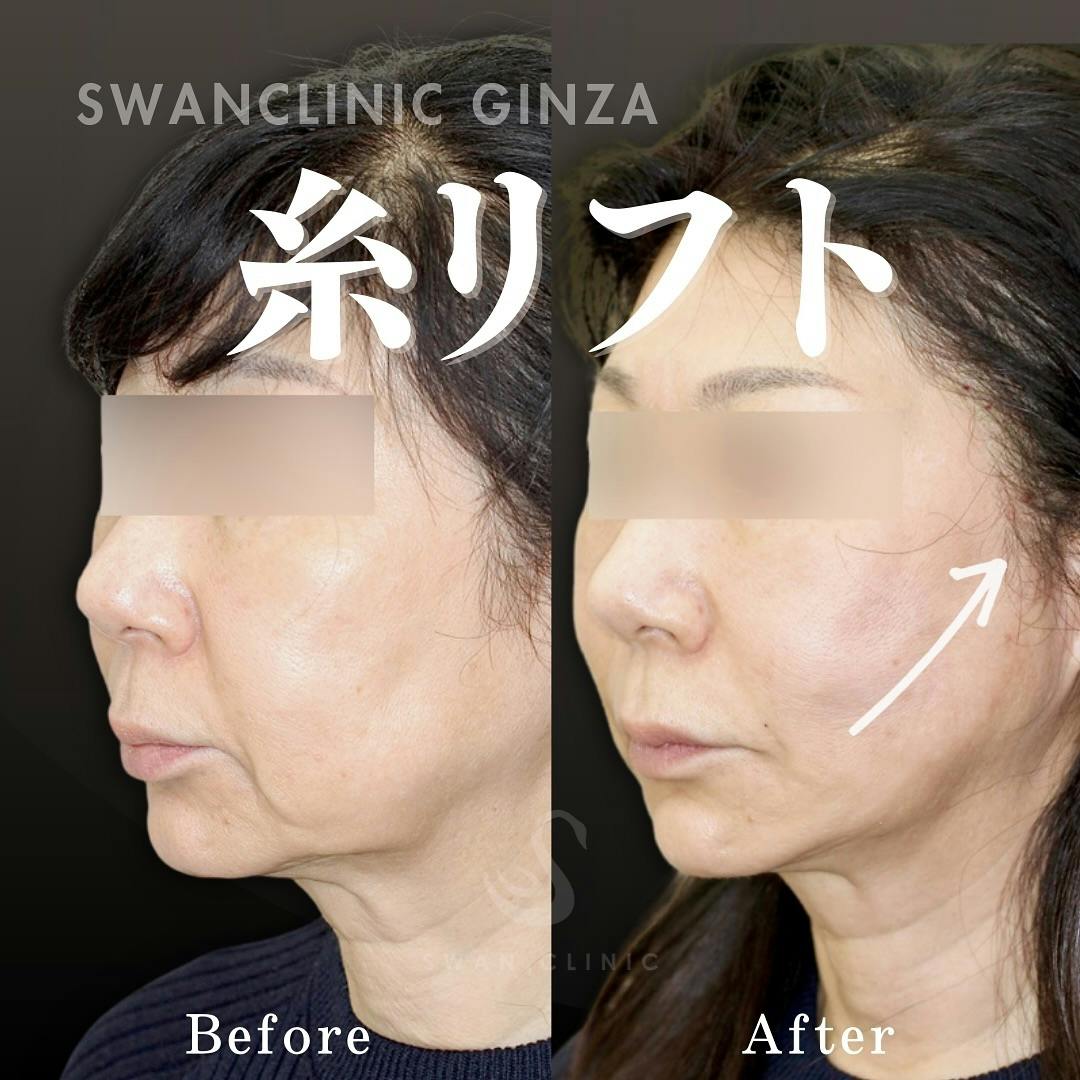 【女性・たるみ】糸リフト ロ横サーマジェント ロ角ヒアルロン酸注入_before_aftar