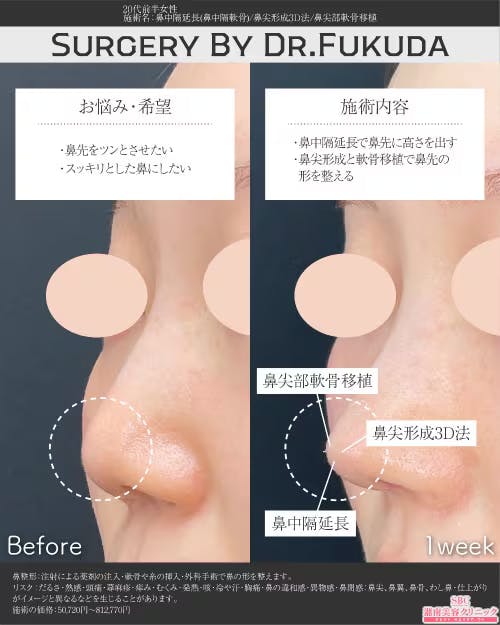 【20代女性・鼻】鼻中隔延長(鼻中隔軟骨)、鼻尖形成3D法、鼻尖部軟骨移植_before_aftar