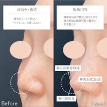 【20代女性・鼻】鼻中隔延長(鼻中隔軟骨)、鼻尖形成3D法、鼻尖部軟骨移植_before_aftar