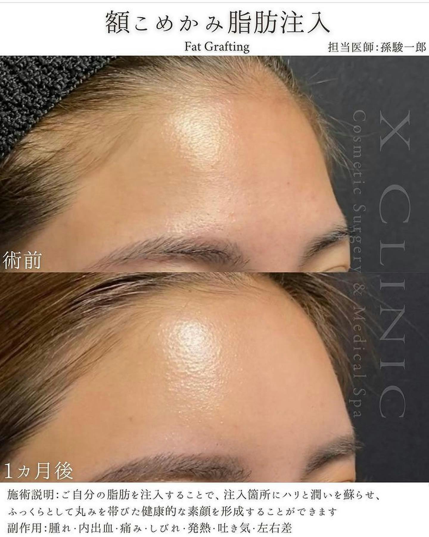 【女性・額】額こめかみ脂肪注入_before_aftar