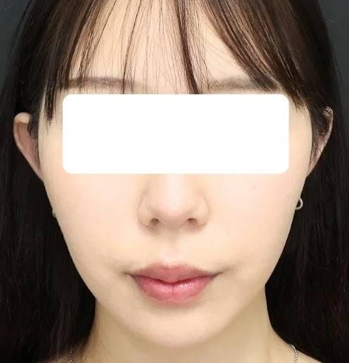 品川スキンクリニック福岡院でフェイスアップ＋脂肪溶解：脂肪溶解注射＋スレッドリフト（エラ）を受けたちゃみさんの写真