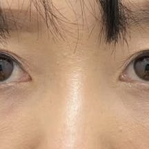 【女性・クマ】目の下の切らないクマ・たるみ(ふくらみ)取り、ナチュラル脂肪注射コンデンスリッチ_after