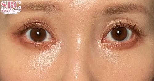 【30代女性・クマ】目の下の切らないクマ・たるみ（ふくらみ）取り、ナチュラル脂肪注射コンデンスリッチ、ナチュラル脂肪注射ナノリッチ_after