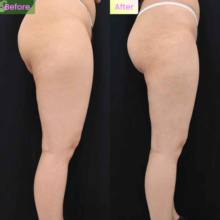 脂肪吸引・お尻の脂肪吸引・太ももの脂肪吸引・膝の脂肪吸引・ベイザー