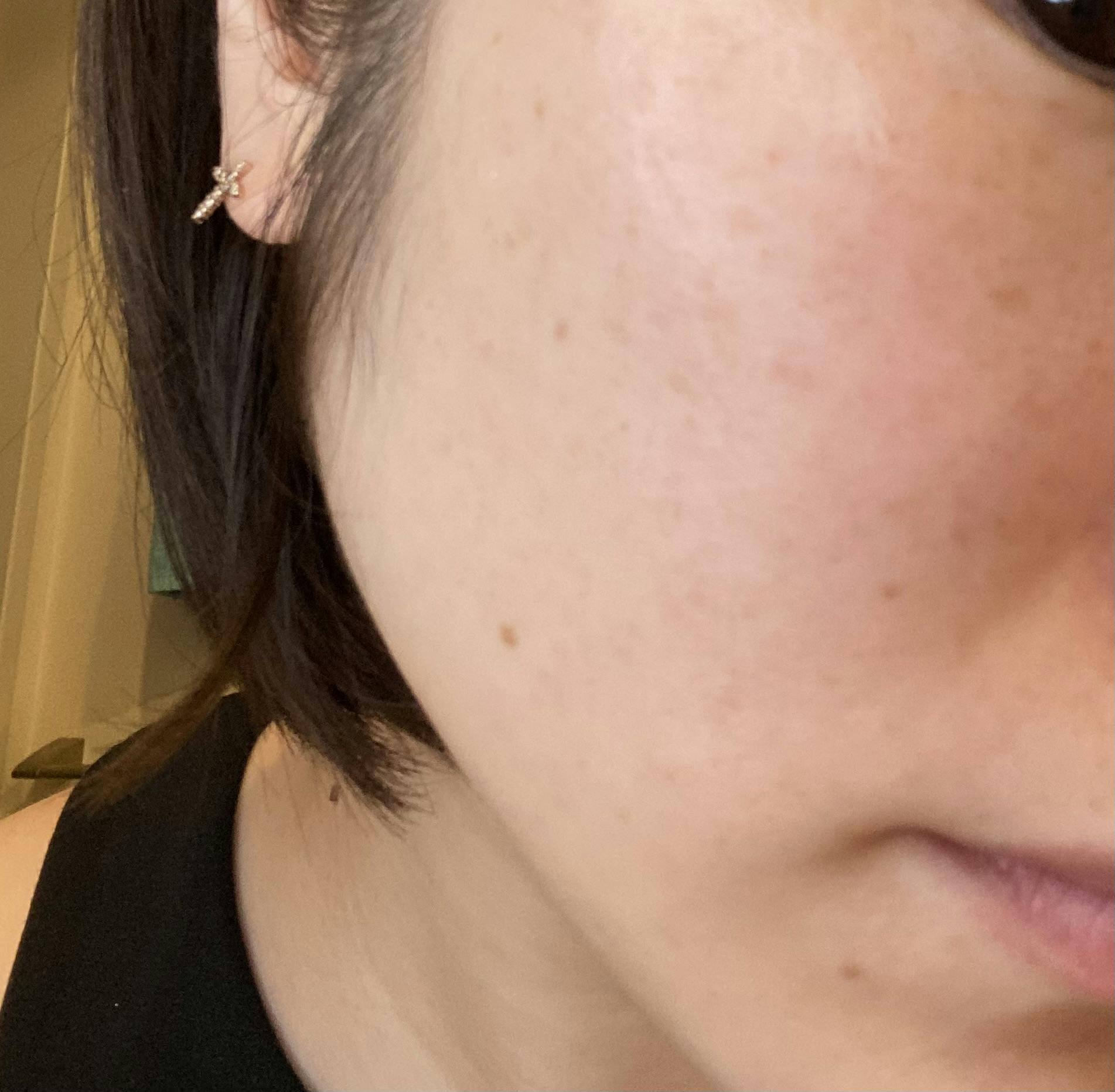 湘南美容皮フ科 新宿東口院でフォトダブルを受けたあっこさんの写真