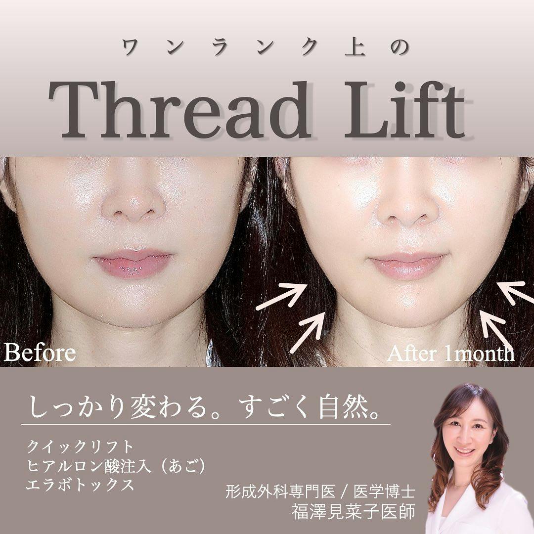 【女性・輪郭】クイックリフト、エラボトックス、ヒアルロン酸（顎）_before_aftar