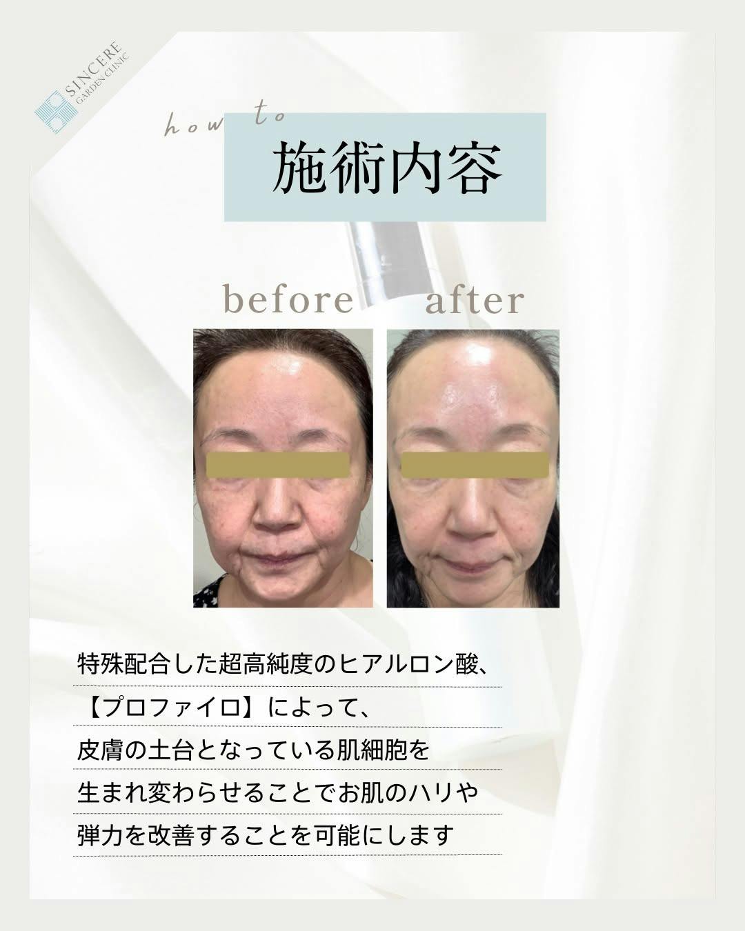 【女性・ハリ】プロファイロ_before_aftar