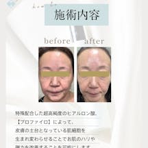 【女性・ハリ】プロファイロ_before_aftar