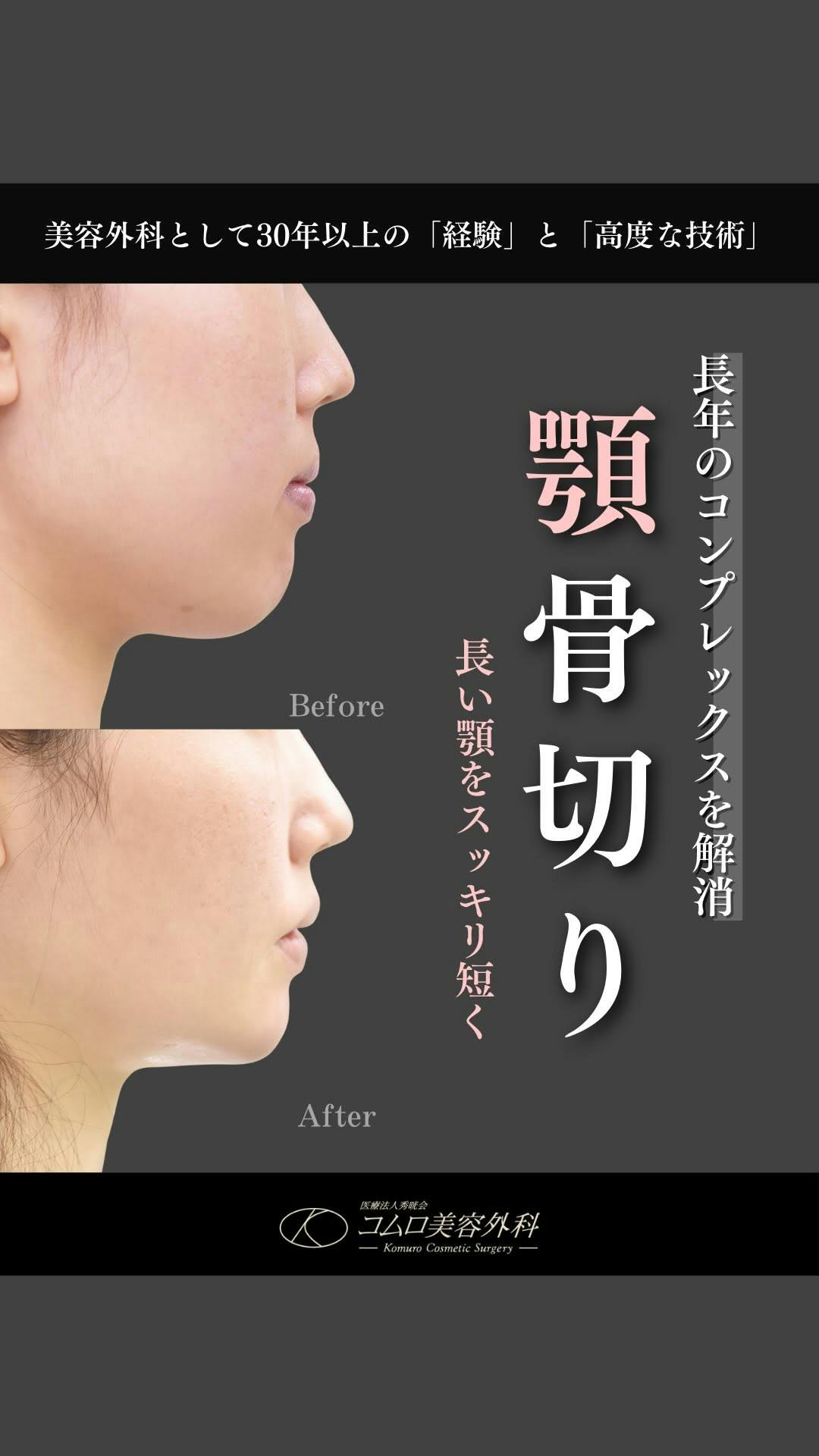 【30代女性・顎】顎骨切り_before_aftar