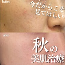 【女性・シミ】ルメッカ_before_aftar