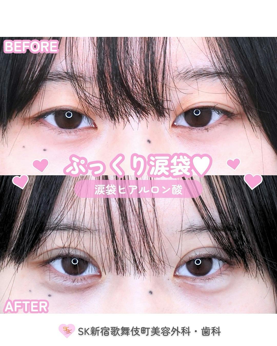 【女性・目元】涙袋ヒアルロン酸_before_aftar