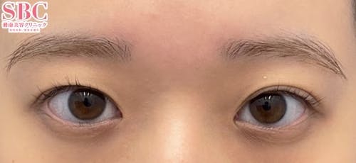 【女性・目元】クイックコスメティーク・ダブルNeo_before