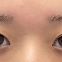 【女性・目元】クイックコスメティーク・ダブルNeo_before