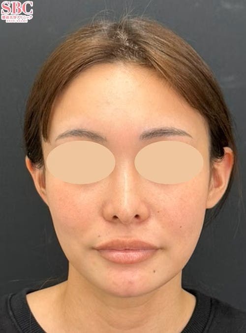 【20代女性・輪郭】ヒアルロン酸ジュビダームビスタ バイクロスシリーズ_before