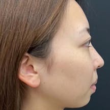 【女性・顔】根こそぎVASER脂肪吸引、ジョールファット除去術、糸リフト、経結膜脱脂、全顔脂肪注入_before