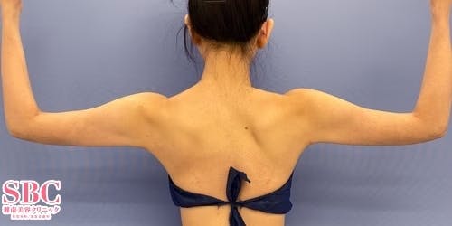 【女性・二の腕】Aquicell（アキーセル）脂肪吸引、根こそぎVASER脂肪吸引_aftar