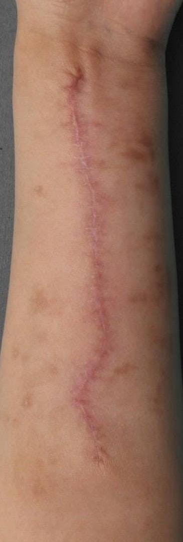 西新宿杉江中央クリニックで傷跡修正:切開法を受けた大貫さんの写真