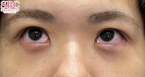 【20代女性・クマ】裏ハムラ法_1day