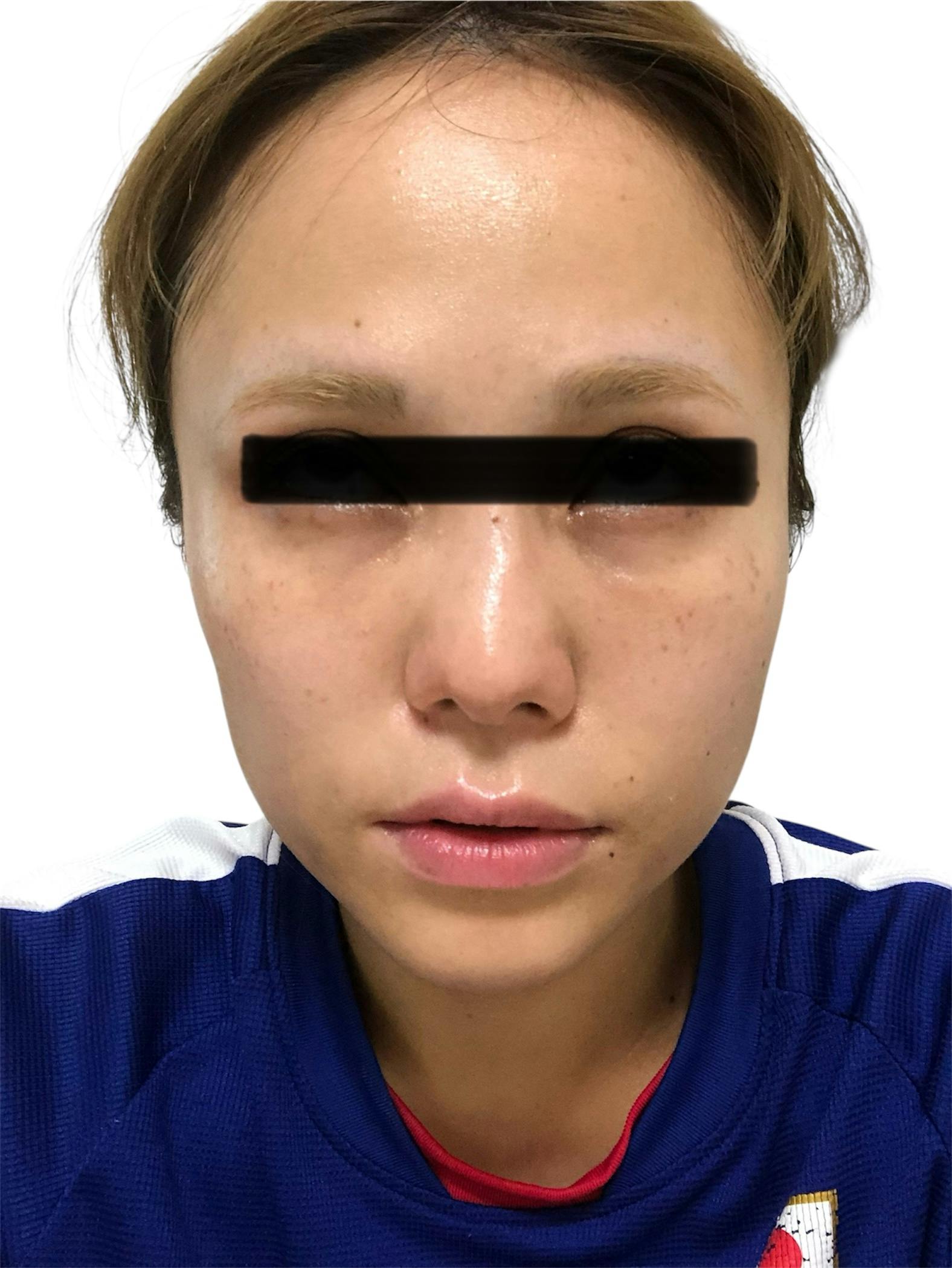 湘南美容クリニック 札幌大通院で目の下のクマ・たるみ取り・・脂肪注入(こめかみ)・脂肪注入(顔)・脂肪注入(ゴルゴ線)・目の下のクマ脂肪注入を受けたりりさんの写真