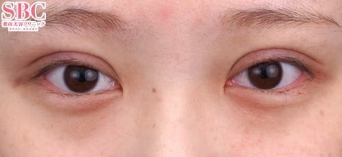 【20代女性・目元】クイックコスメティーク・トリプルNeo_0day