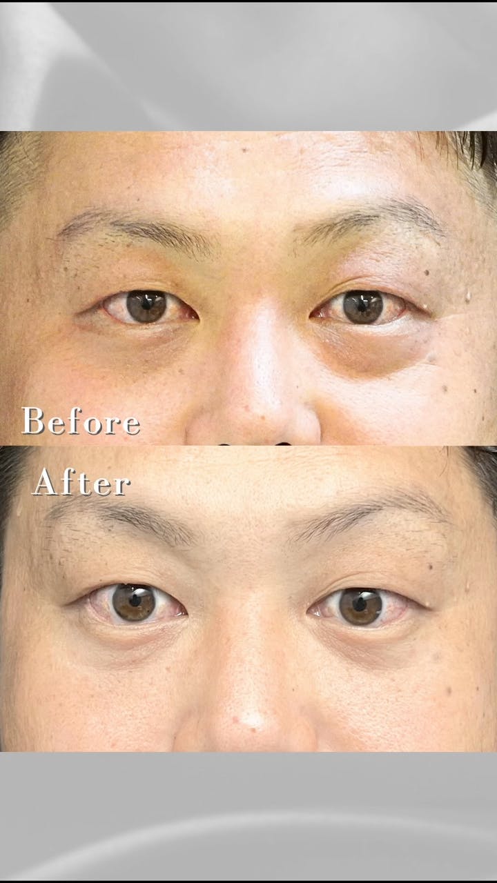 【男性・目元】経結膜脱脂術_before_aftar