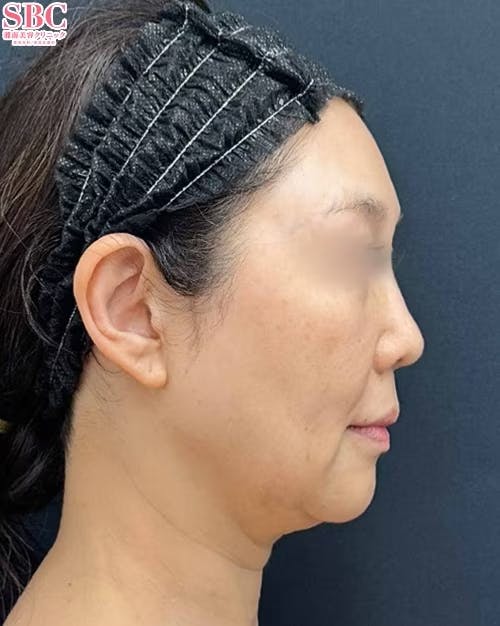 【女性・顔】小顔用脂肪吸引注射・エンブレイスRF・糸リフト_before