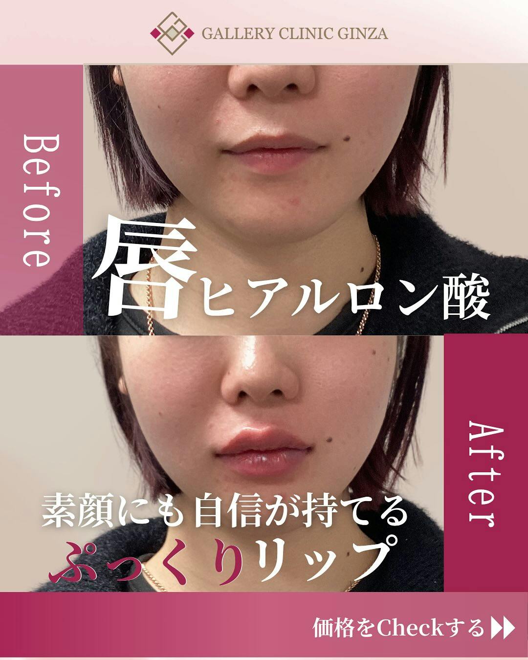 【女性・唇】ヒアルロン酸(唇)_before_aftar