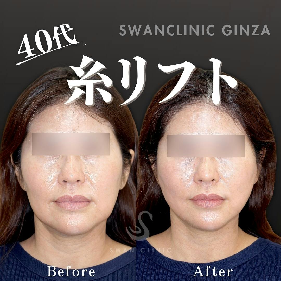 【40代女性・たるみ】糸リフト 口横サーマジェン 口角ヒアルロン酸注入_before_aftar