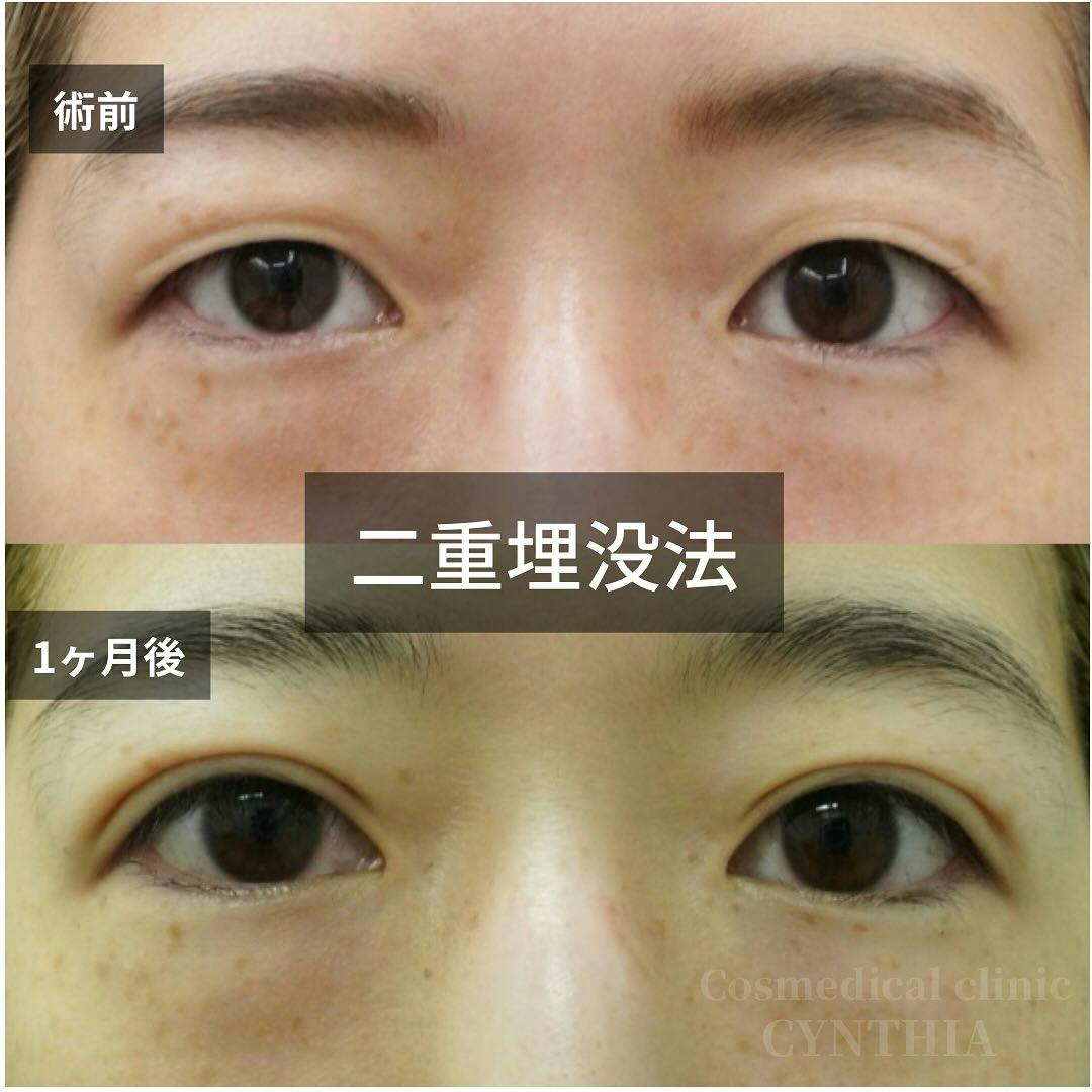 【30代女性・目元】二重埋没法_before_aftar
