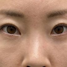 【30代女性・目元】ナチュラル脂肪注射コンデンスリッチ 目の下の切らないクマ・たるみ(ふくらみ)取り_after