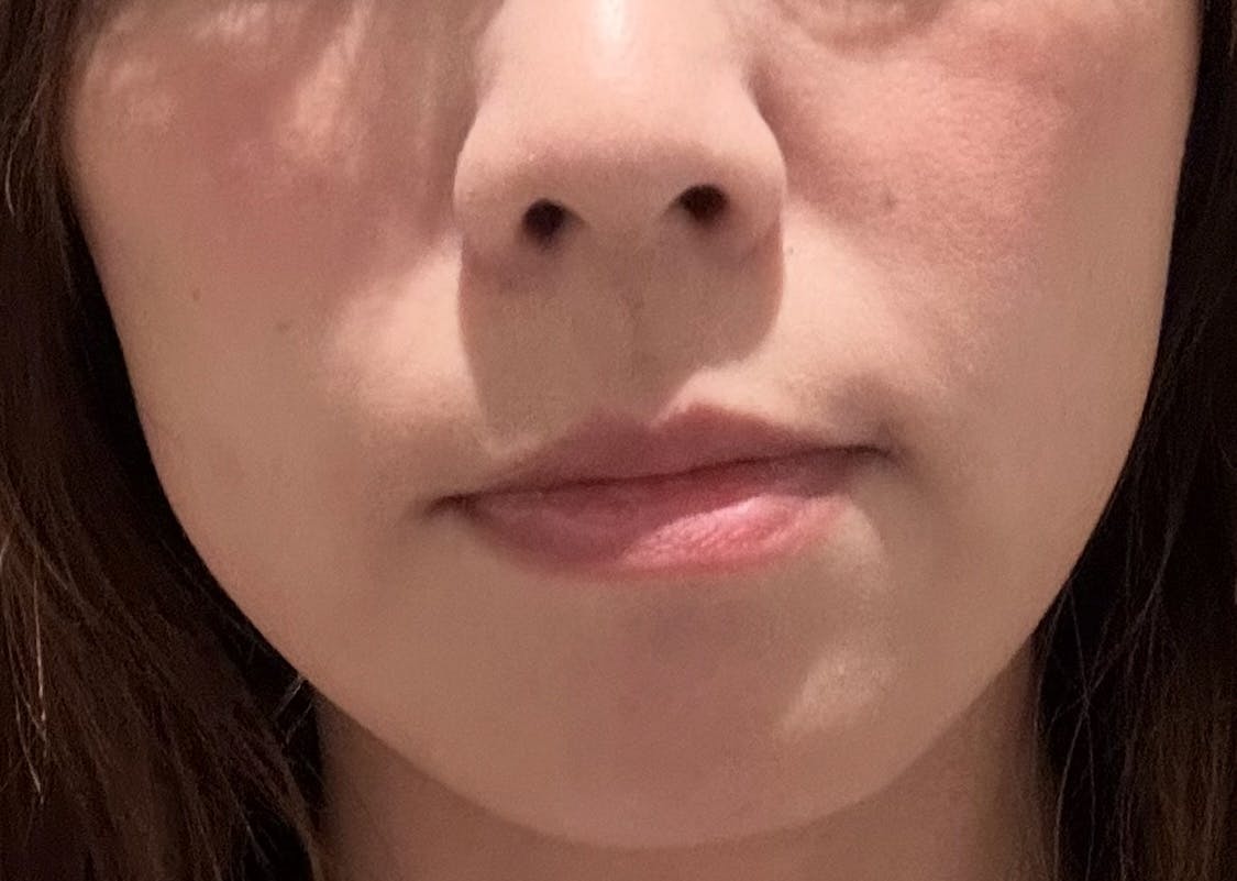 DMTC美容皮膚科 日本橋院で糸リフトを受けたまろんさんの写真