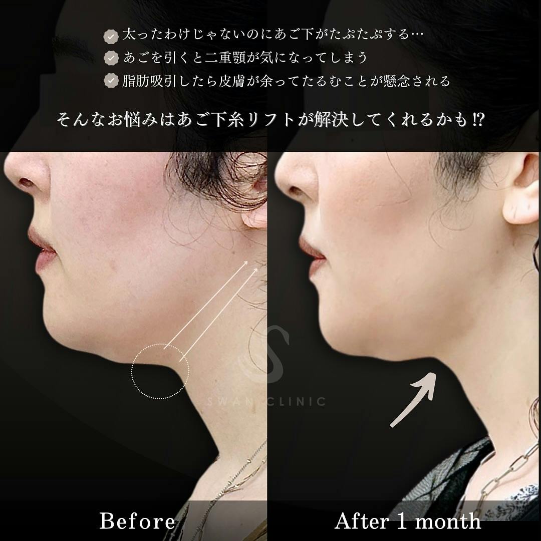 【女性・たるみ】あご下糸リフト_before_aftar
