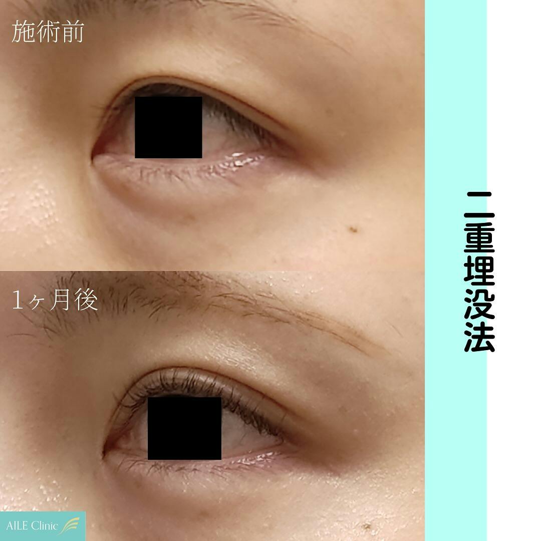 【女性・目元】二重埋没法_before_aftar