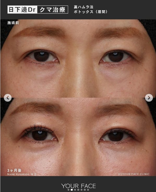 【女性・クマ】裏ハムラ法_before_aftar