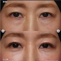 【女性・クマ】裏ハムラ法_before_aftar