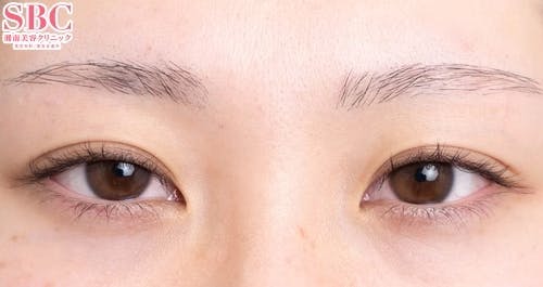【10代女性・目元】眼瞼下垂＋二重_before