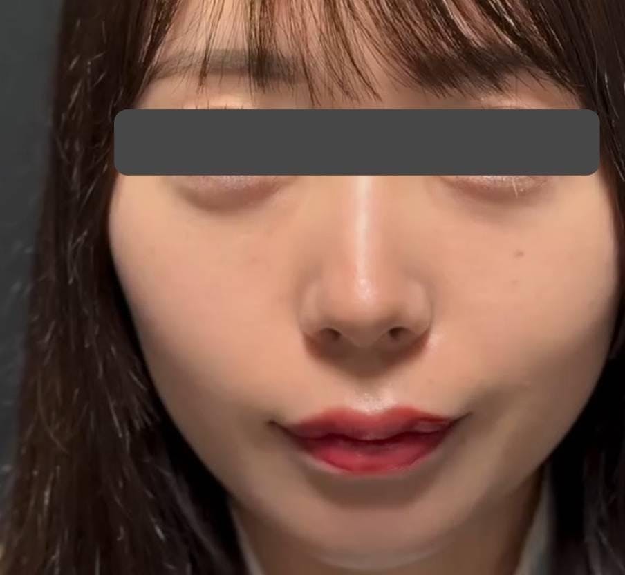 湘南美容クリニック 広島院で目の下の切らないクマ取り+ヒアルロン酸注入：裏ハムラ法、ヒアルロン酸注入を受けたビーバーさんの写真