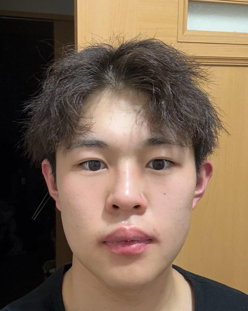 TCB東京中央美容外科 本厚木院で二重整形・二重埋没・上瞼の脂肪・たるみ取り・マイクロカット法を受けたショウさんの写真
