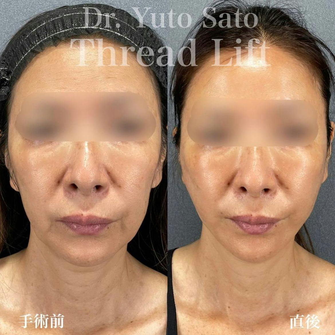【女性・輪郭】糸リフト_before_aftar