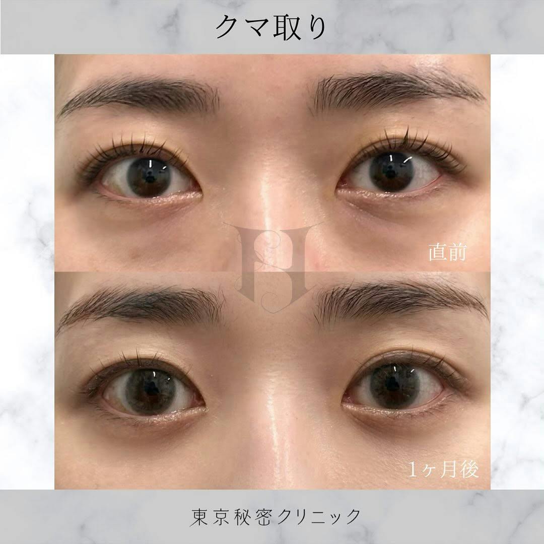 【女性・目元】クマ取り_before_aftar