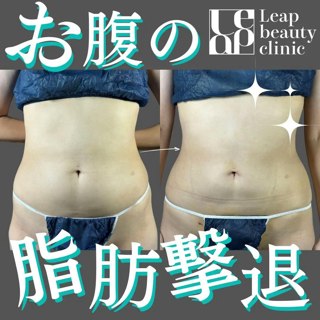 【30代女性・腹部】腹部脂肪吸引_before_aftar