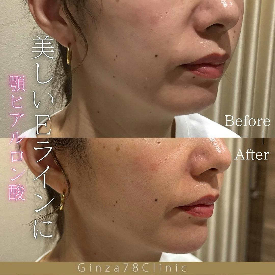 【女性・輪郭】ヒアルロン酸_before_aftar