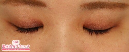 【女性・目元】クイックコスメティーク・ダブルNeo、SBC『デカ目』術、自然癒着セット（上眼瞼脱脂）_aftar