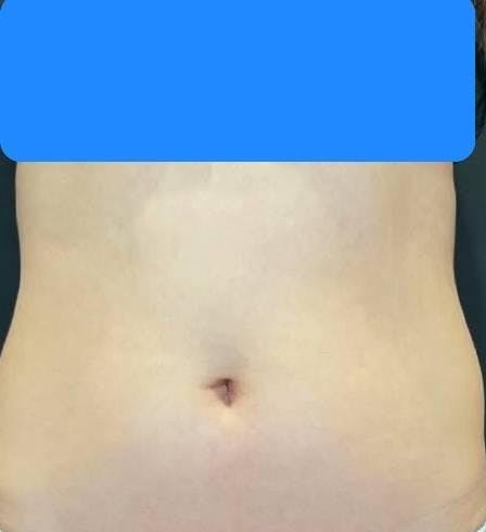 ワムクリニック銀座(WOM CLINIC GINZA)でボディ脂肪吸引：腰の脂肪吸引を受けたNENEさんの写真